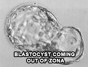 blastocyst coming out of zona