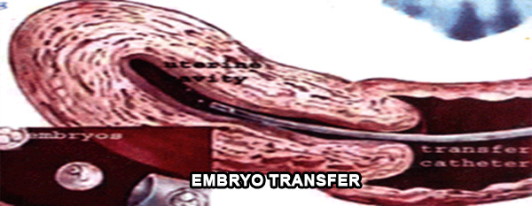 embryo transfer