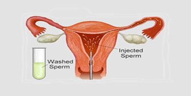iui treatment