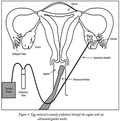 ivf treatment